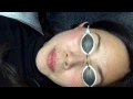 Laser treatment for pigmentation and rejuvenation - Revlite