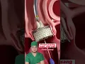 Download Lagu Proses pasang Ring Jantung atau Cincin Jantung #cardio #cardiology #ringjantung