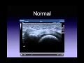 Download Lagu Forefoot Pain with Daniel Walkley