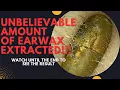 Download Lagu UNBELIEVABLE Amount Of Earwax Extracted From This Ear!!! (Watch Until The End)