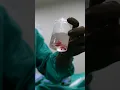 Download Lagu Incomplete abortion: Hysteroscopic removal of products | Dr Rhythm Gupta - IVF Specialist in Delhi