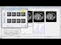 Lung Nodule Detection And Classification Using Neural Network And SVM With Fractal Features
