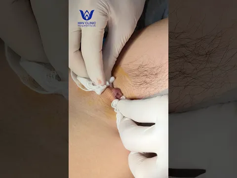 Nặn mụn áp xe vùng nách nhiều dịch mủ.