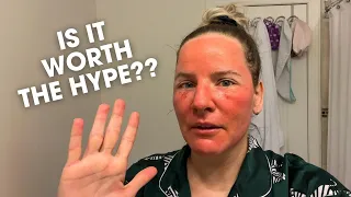 My CO2 Laser Recovery Aftercare Results