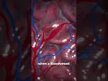 Download Lagu Brain Aneurysm Meme