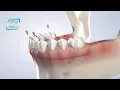 Full-Arch Restoration at Fresno Oral Maxillofacial Surgery Dental Implant Center