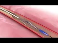 FLEX Catheter Animation