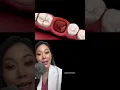 How to avoid dry socket after wisdom tooth extraction