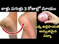 Download Lagu కాళ్లపగుళ్లు చిటికెలో తగ్గించే పైసా ఖర్చు లేని చిట్కా | cracked heels  home remedy | kaallu pagullu
