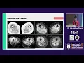 AMS2026 DAY2 HALL A 5 Muscle MRI in Myopathies and Denervation Pattern Recognition for Diagnosis