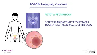 What Is PSMA Imaging ZERO Prostate Cancer Curium