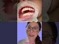 Download Lagu Get VAMPIRE FANGS at the dentist with composite bonding #vampire