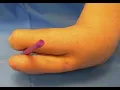 Krukenberg procedure CPT code - simplify medical coding
