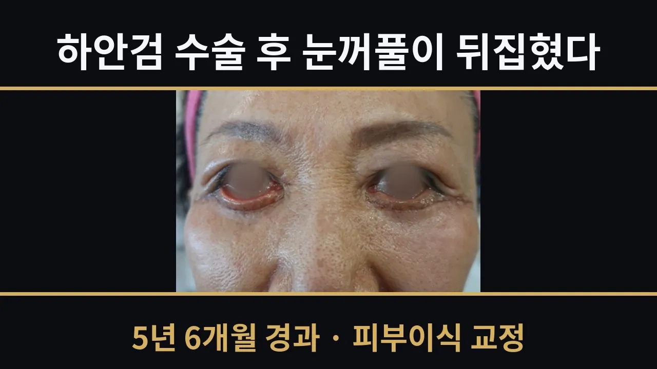 하안검 수술 후 눈꺼풀이 뒤집혔습니다 — 피부이식으로 교정한 5년 6개월 경과#하안검성형 #하안검부작용 #안검외반 #눈꺼풀뒤집힘 #하안검재수술#연세자연미