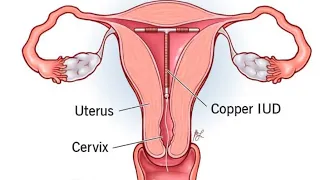 Live Kuboneza Urubyaro Agapira Ko Mumura 