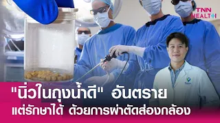 การรักษาโรคนิ่วในถุงน้ำดีทำอย่างไรบ้าง