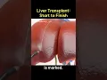 Lagu Liver Transplant: Start to Finish