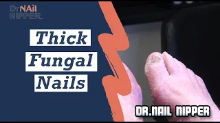 Download Thick Fungal Nails (2020) MP3