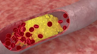 DYSLIPIDEMIA What is it