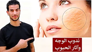 وصفة سحرية لازالة اثار الحبوب وندبات الوجه والجلد في اسرع وقت 