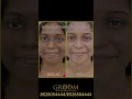 Download Lagu Skin Lightening Treatment Transformation ✨