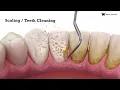 Scaling Teeth Cleaning Teeth Scaling Scaling And Polishing Dental Aesthetics
