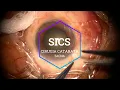 Download Lagu SICS - Cirugía de Catarata Incisión Pequeña - Centro Integral de Oftalmología - Tacna 2021