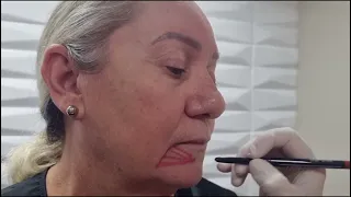 Preenchimento do sulco lateral mentual. Como eu faço.