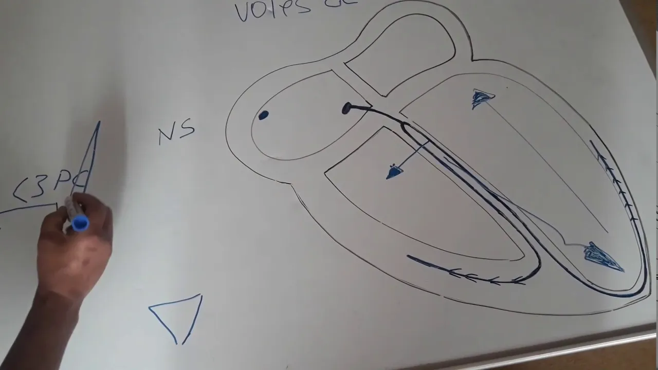 ECG: Interpretation très facile de L'ECG.(5ème partie).