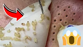 extra o de cravos satisfat ria limpeza de pele comentada por esteticista 356423