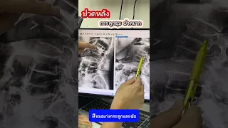 กระดูกสันหลังยุบเกิดจากสาเหตุอะไร และมีผลต่อร่างกายอย่างไรบ้าง 