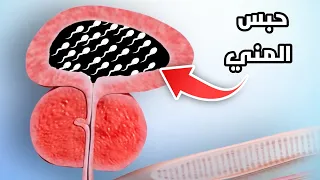 شاهد ماذا يحدث لجسم الرجل عند حبس السائل المنوي                  دندنها