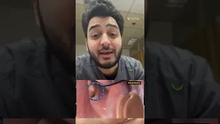 تسارع ضربات القلب العلاج بالكي 