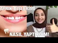 Download Lagu ÜCRETSİZ ŞEKİLDE AYRIK DİŞLERİMİ NASIL YAPTIRDIM? | BONDİNG İŞLEMİ🦷