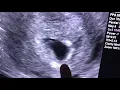 Sonogram 6 weeks pregnant