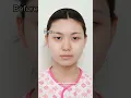 I decided to get double eyelid surgery in Korea