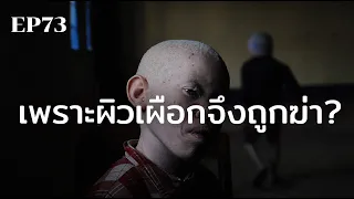 โรคผิวเผือกเกิดจากสาเหตุอะไร และมีลักษณะทางพันธุกรรมอย่างไร