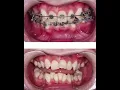 CROOKED TEETH TO PERFECT SMILE - Braces Magic Before After
