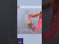 Constipation