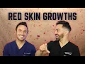 Cherry Angiomas and How to Treat Them Doctorly Debunked