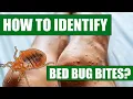 How To Identify Bed Bug Bites - Can Doctors or Exterminators Identify Bed Bug Bites