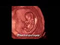 Download Lagu 3D ultrasound at 11 weeks of pregnancy