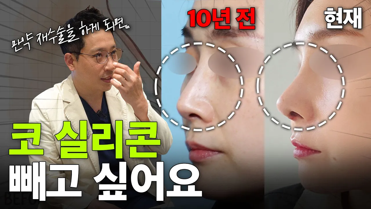 "코 성형 했는데.. 실리콘, 염증 생기기 전에 빼고 싶어요" 의사가 말하는 코 재수술, 보형물 제거의 진실