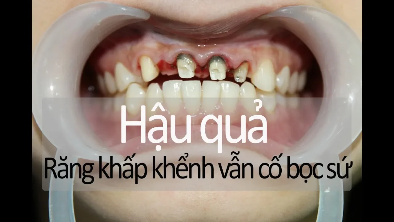 Outline Video Có nên bọc sứ cho răng khấp khểnh không? Hậu quả làm răng sứ sai cách (xâm phạm khoảng sinh học)