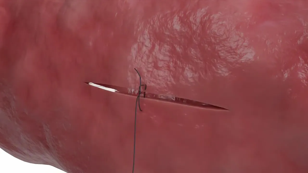 StitchLock in Action