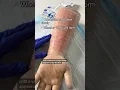 TB Skin Test