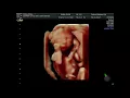 Ultrasound Scan of Baby at 18 weeks