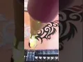 Download Lagu Fast tattoo removal by Picosecond laser machine