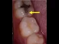 Kill tooth pain instantly under 10 1 Product no lie 100