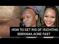 Download Lagu HOW I GOT RID OF ISICHITHO ACNE FAST| ACNE TREATMENT. #acne #thabanglubri